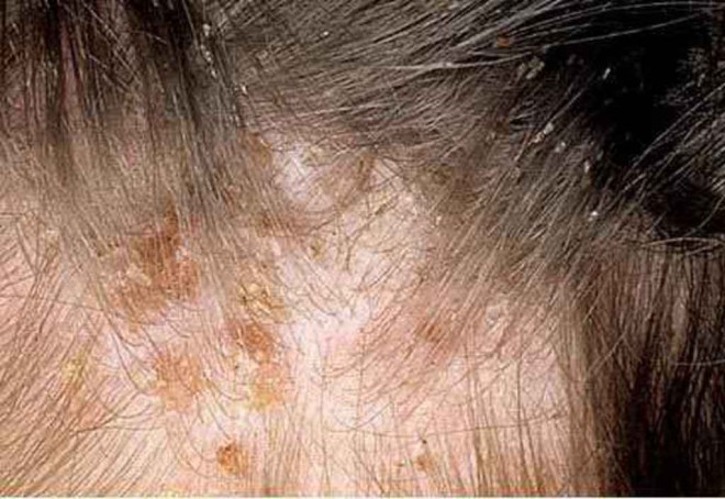 Les morsures et les lentes sont des signes sûrs de poux