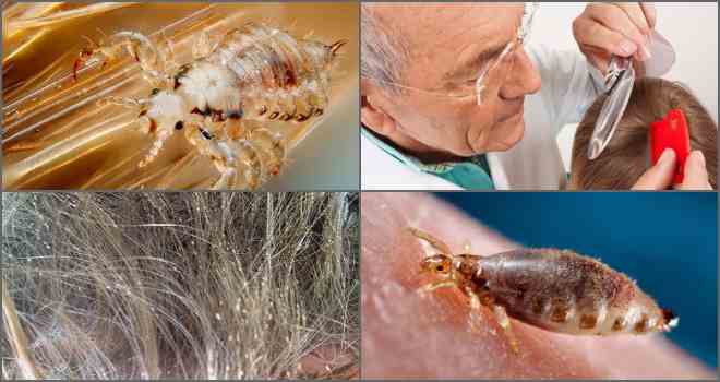 Poux bruns, leurs larves ─ blanches