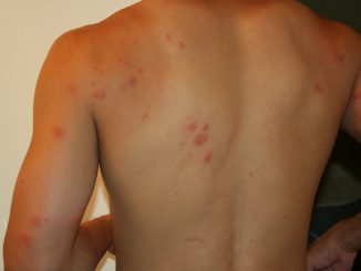 comment les puces piquent une personne