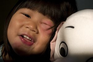 moucheron oculaire mordant que soulager l'enflure