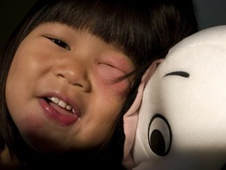 moucheron oculaire que soulager l'enflure