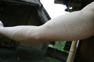 piqûres de puces comment traiter