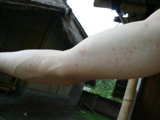 piqûres de puces comment traiter