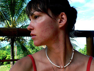 comment guérir une tique sous-cutanée sur le visage