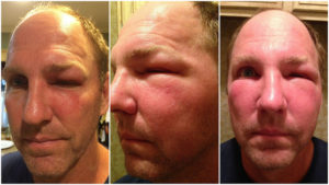 comment enlever un gonflement d'une piqûre d'abeille