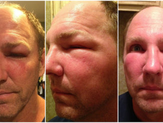 comment enlever un gonflement d'une piqûre d'abeille