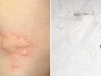 punaises de lit sur les symptômes d'une personne