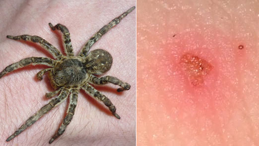 Tarentula Spider Bite