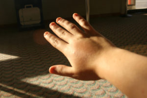 allergie à une piqûre de moustique chez un enfant