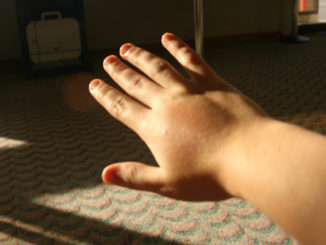 allergie à une piqûre de moustique chez un enfant