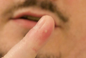 que se passera-t-il si l'araignée mord