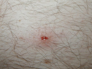 comment retirer la tête de tique