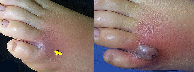 sur la photo de gauche - une morsure au début, à droite - le jour 3